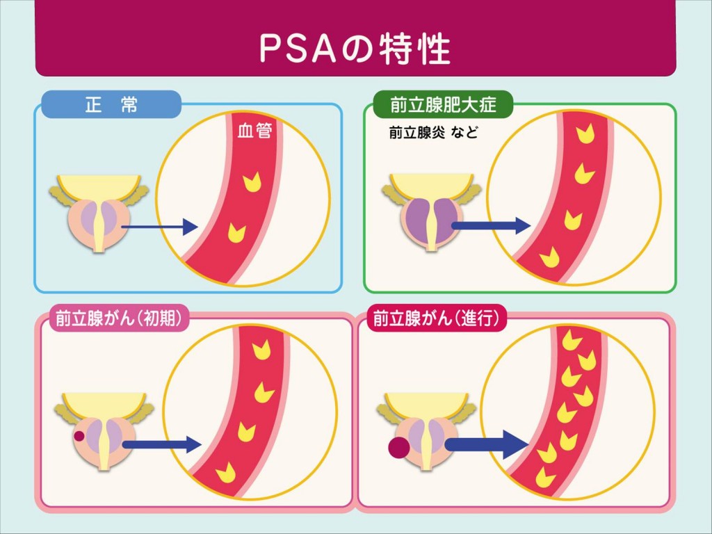 PSA検査はどのように実施されるのですか?