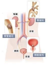 尿路結石  いまもと泌尿器科クリニック